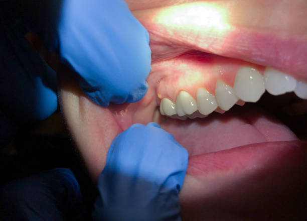 Best Emergency Dental Care for Abscessed Tooth in Point Of Rocks, MD